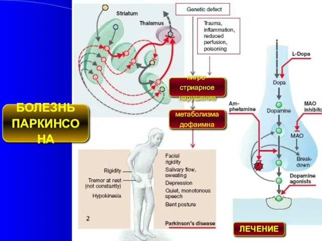 БОЛЕЗНЬ ПАРКИНСОНА нигро-стриарное нарушение метаболизма дофаимна ЛЕЧЕНИЕ