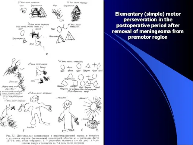 Elementary (simple) motor perseveration in the postoperative period after removal of meningeoma from premotor region