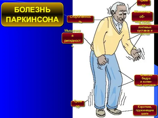 БОЛЕЗНЬ ПАРКИНСОНА Мышечная ригидность Сгорбленность Тремор Маскоподоб- ное лицо Флексия локтевых суставов