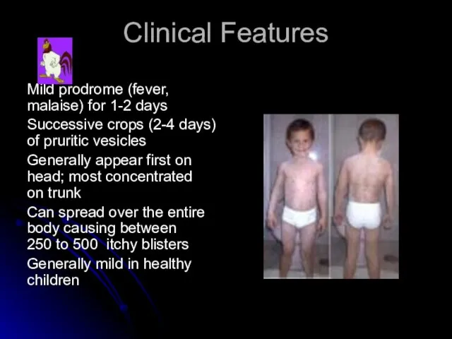 Clinical Features Mild prodrome (fever, malaise) for 1-2 days Successive crops (2-4