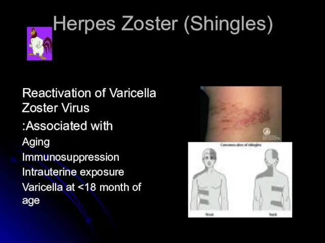 Herpes Zoster (Shingles) Reactivation of Varicella Zoster Virus Associated with: Aging Immunosuppression Intrauterine exposure Varicella at