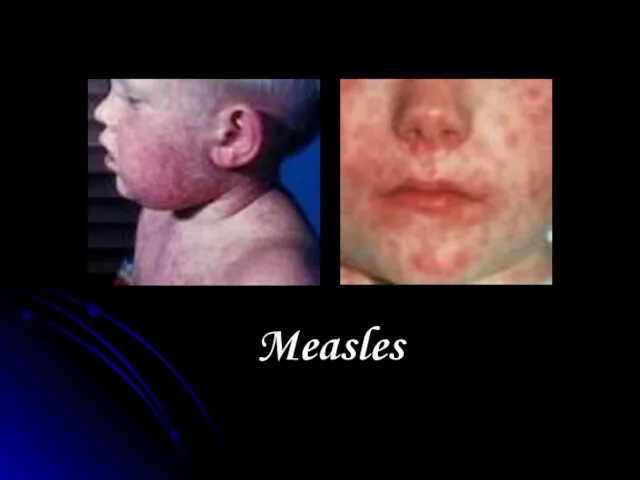 Measles