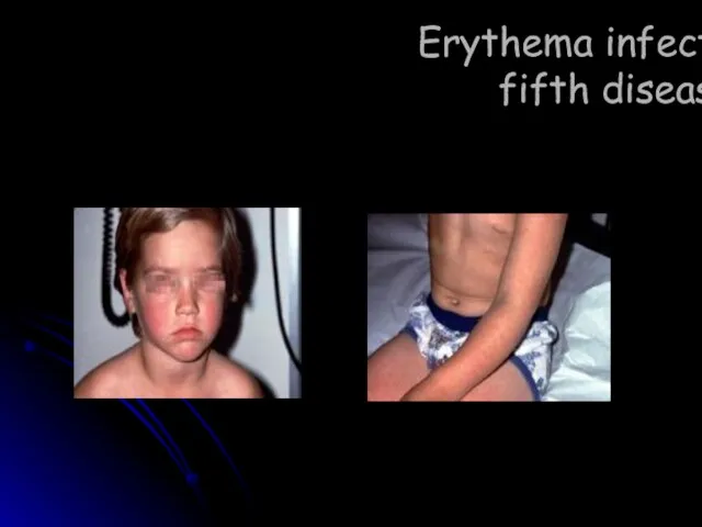 Erythema infectiosum fifth disease