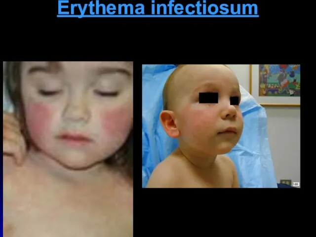 Erythema infectiosum