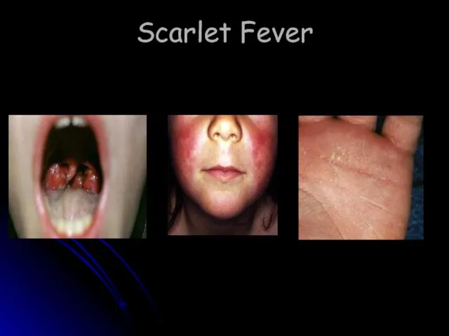 Scarlet Fever