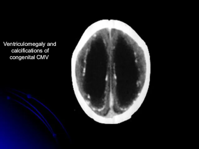 Ventriculomegaly and calcifications of congenital CMV