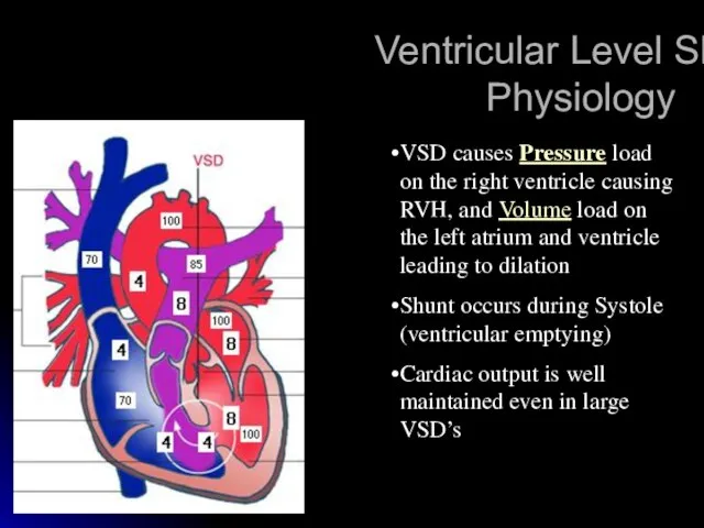 Ventricular Level Shunt: Physiology VSD causes Pressure load on the right ventricle