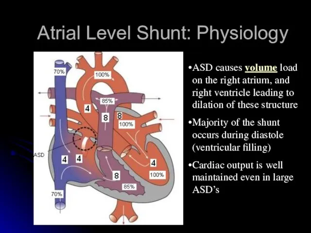 Atrial Level Shunt: Physiology ASD causes volume load on the right atrium,