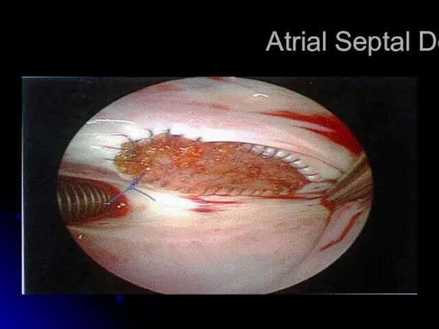 Atrial Septal Defect