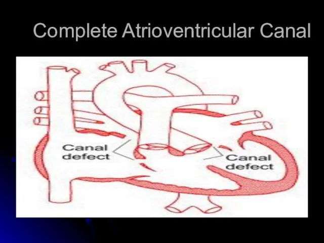 Complete Atrioventricular Canal