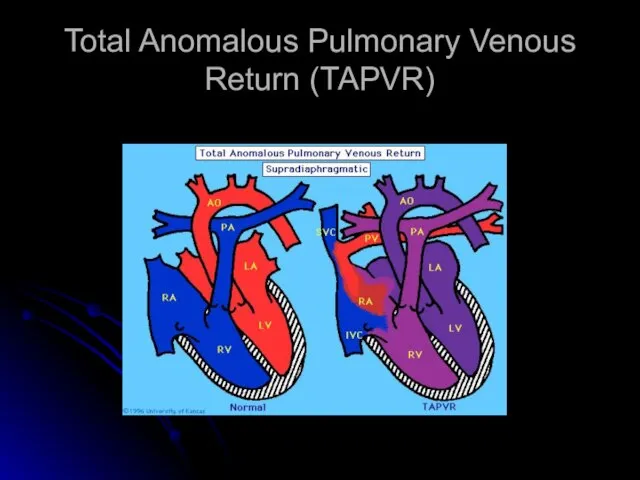 Total Anomalous Pulmonary Venous Return (TAPVR)