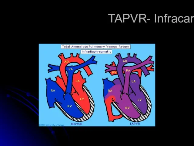TAPVR- Infracardiac