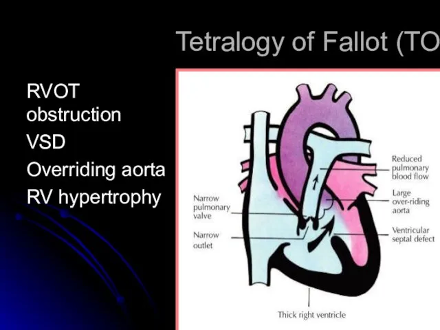 Tetralogy of Fallot (TOF) RVOT obstruction VSD Overriding aorta RV hypertrophy