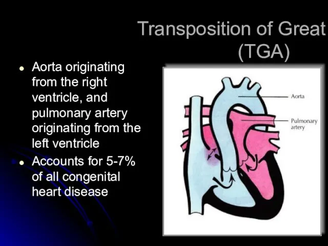 Transposition of Great Areries (TGA) Aorta originating from the right ventricle, and