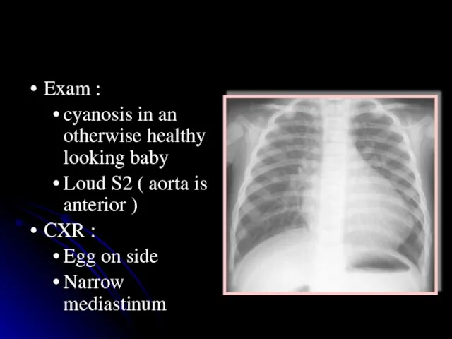 TGA Exam : cyanosis in an otherwise healthy looking baby Loud S2