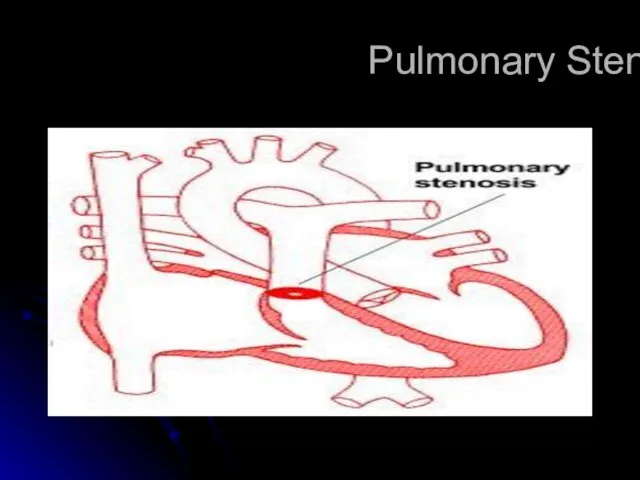 Pulmonary Stenosis