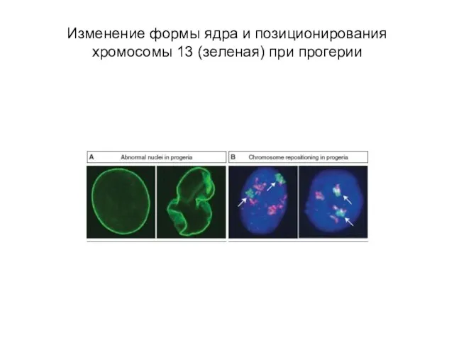 Изменение формы ядра и позиционирования хромосомы 13 (зеленая) при прогерии