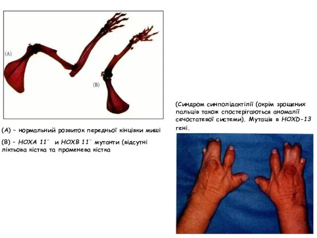 (А) – нормальний розвиток передньої кінцівки миші (В) – НОХА 11– и