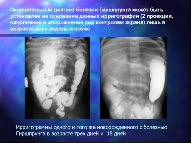 Ирригограммы одного и того же новорожденного с болезнью Гиршпрунга в возрасте трех