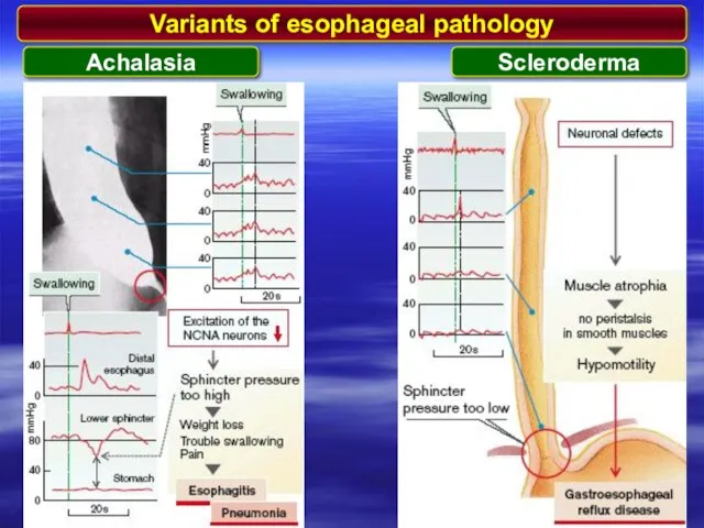 Variants of esophageal pathology Achalasia Scleroderma