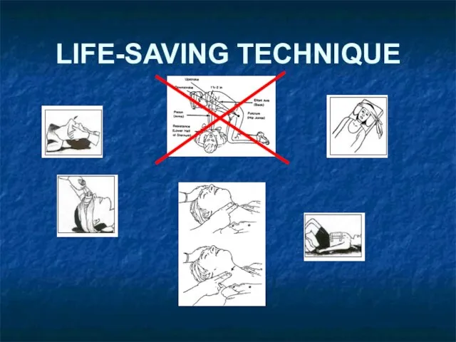 LIFE-SAVING TECHNIQUE