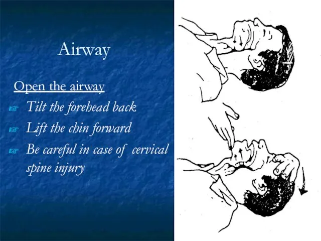 Airway Open the airway Tilt the forehead back Lift the chin forward