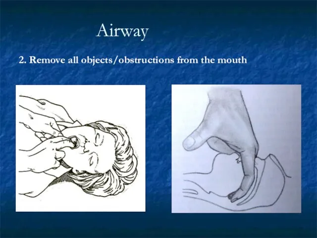 Airway 2. Remove all objects/obstructions from the mouth