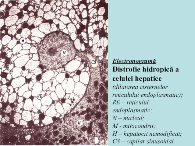 Electronogramă. Distrofie hidropică a celulei hepatice (dilatarea cisternelor reticulului endoplasmatic); RE –