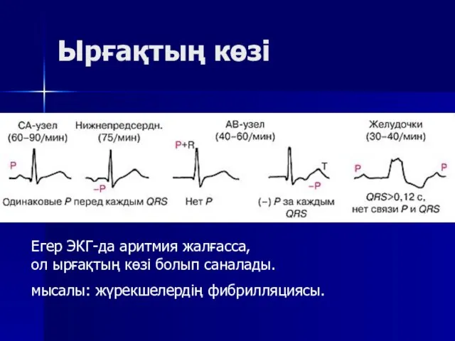 Ырғақтың көзі Егер ЭКГ-да аритмия жалғасса, ол ырғақтың көзі болып саналады. мысалы: жүрекшелердің фибрилляциясы.