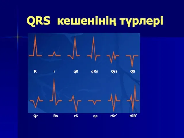 QRS кешенінің түрлері