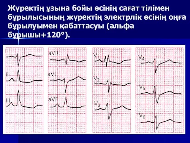 Жүректің ұзына бойы өсінің сағат тілімен бұрылысының жүректің электрлік өсінің оңға бұрылуымен қабаттасуы (альфа бұрышы+120°).