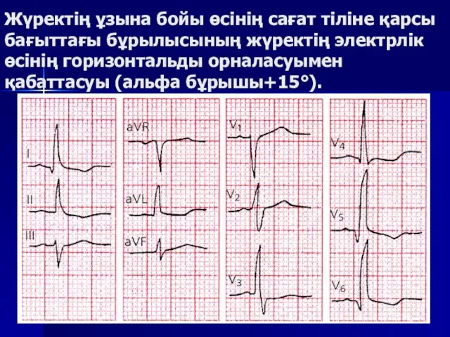 Жүректің ұзына бойы өсінің сағат тіліне қарсы бағыттағы бұрылысының жүректің электрлік өсінің