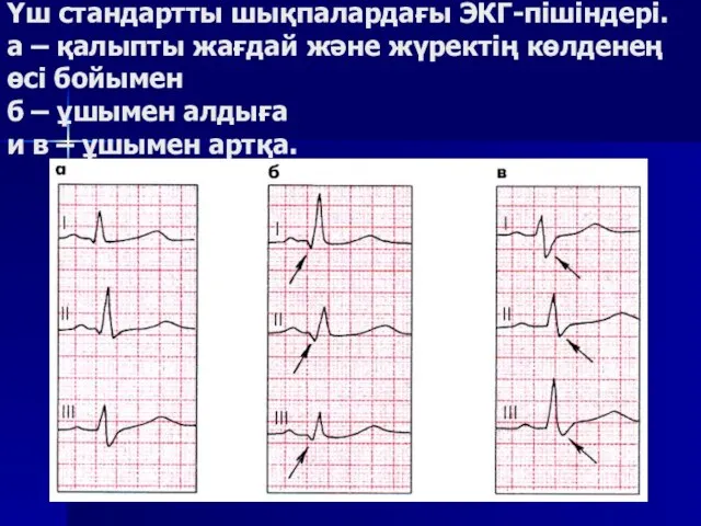 Үш стандартты шықпалардағы ЭКГ-пішіндері. а – қалыпты жағдай және жүректің көлденең өсі