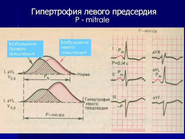 Возбуждение Правого предсердия Возбуждение левого предсердия Гипертрофия левого предсердия Р - mitrale