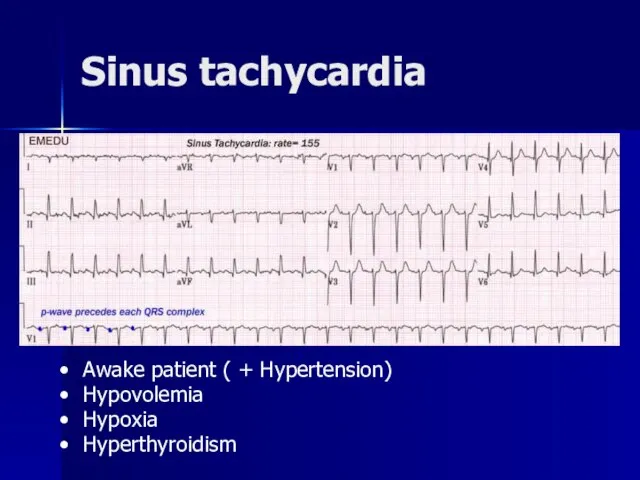 Sinus tachycardia Awake patient ( + Hypertension) Hypovolemia Hypoxia Hyperthyroidism