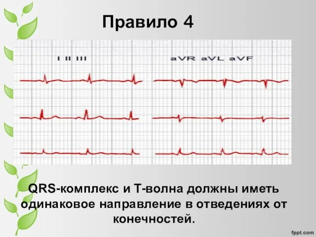 Правило 4 QRS-комплекс и T-волна должны иметь одинаковое направление в отведениях от конечностей.