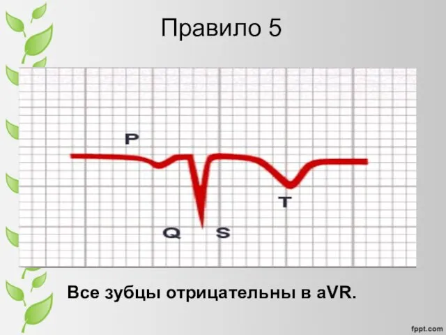 Правило 5 Все зубцы отрицательны в aVR.