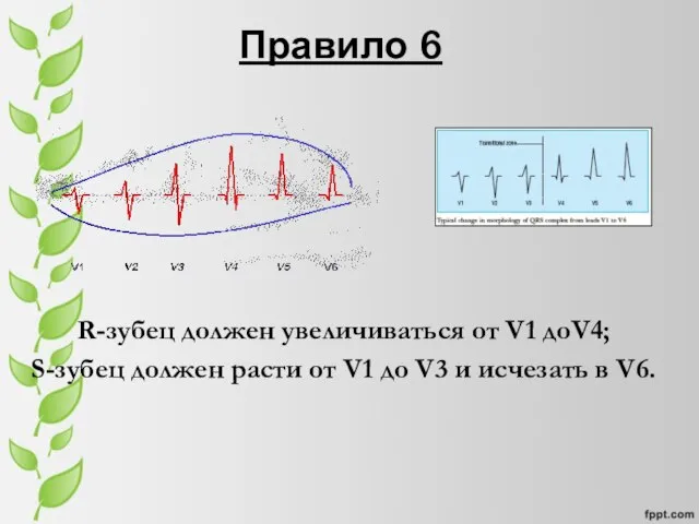 Правило 6 R-зубец должен увеличиваться от V1 доV4; S-зубец должен расти от