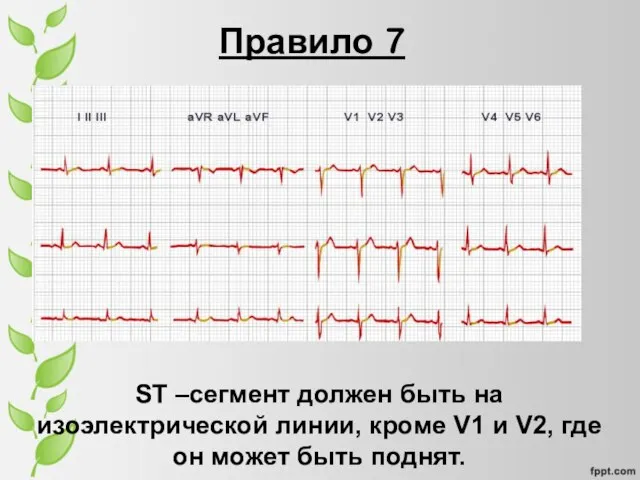 Правило 7 ST –сегмент должен быть на изоэлектрической линии, кроме V1 и