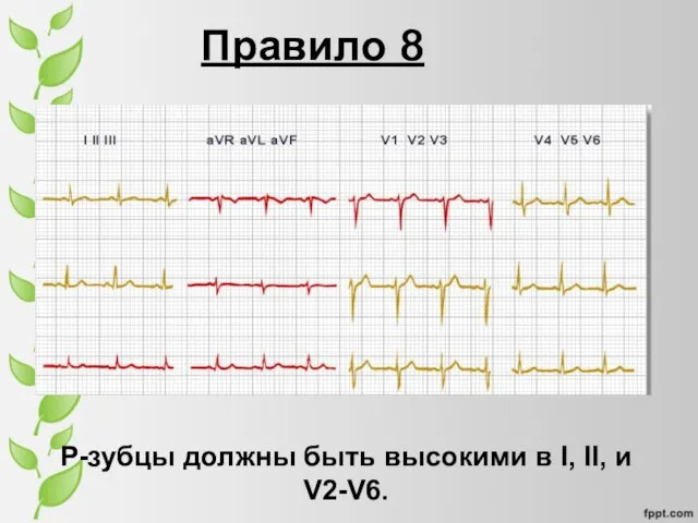 Правило 8 P-зубцы должны быть высокими в I, II, и V2-V6.