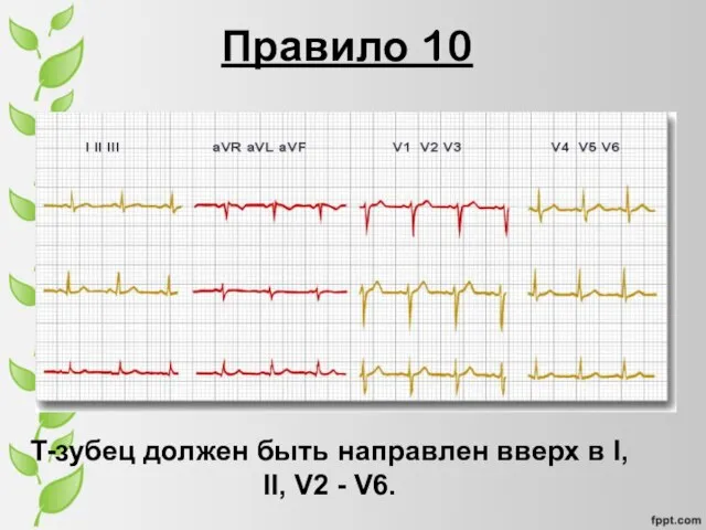 Правило 10 T-зубец должен быть направлен вверх в I, II, V2 - V6.