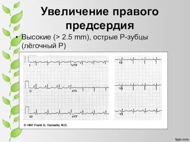 Увеличение правого предсердия Высокие (> 2.5 mm), острые P-зубцы (лёгочный P)