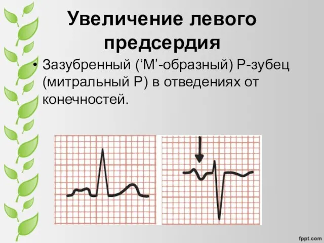 Зазубренный (‘M’-образный) P-зубец (митральный P) в отведениях от конечностей. Увеличение левого предсердия