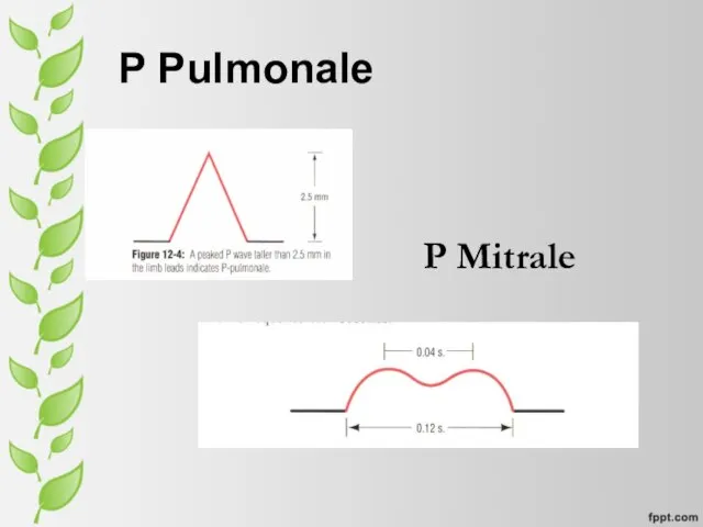 P Pulmonale P Mitrale