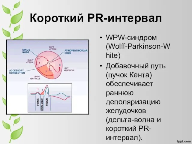 Короткий PR-интервал WPW-синдром (Wolff-Parkinson-White) Добавочный путь (пучок Кента) обеспечивает раннюю деполяризацию желудочков (дельта-волна и короткий PR-интервал).