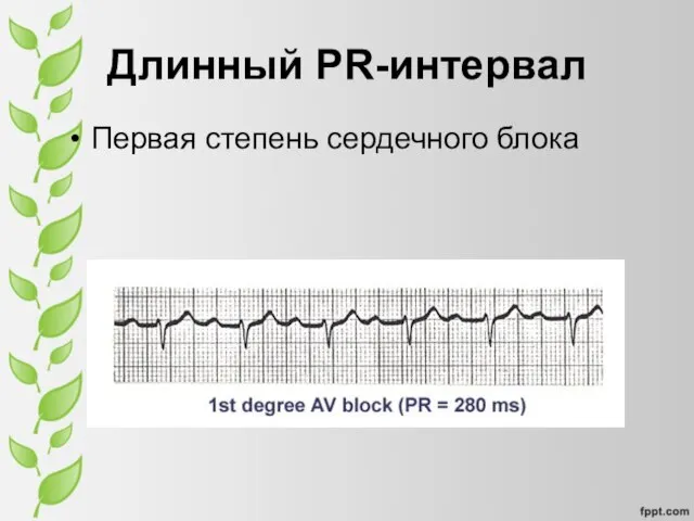 Длинный PR-интервал Первая степень сердечного блока