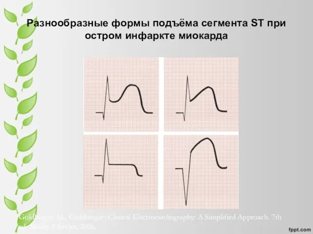 Разнообразные формы подъёма сегмента ST при остром инфаркте миокарда Goldberger AL. Goldberger: