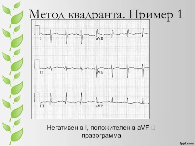 Метод квадранта. Пример 1 Негативен в I, положителен в aVF ? правограмма