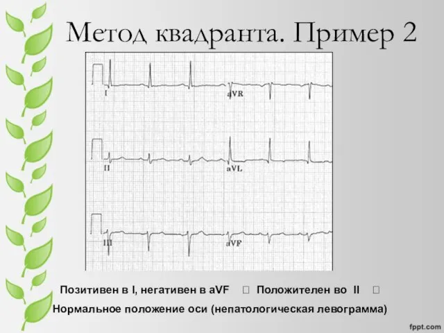 Метод квадранта. Пример 2 Позитивен в I, негативен в aVF ? Положителен