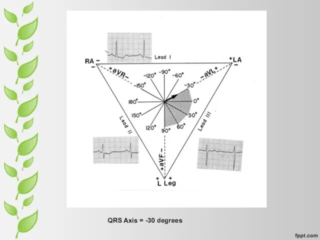 QRS Axis = -30 degrees